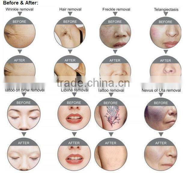 hair removal ipl machine