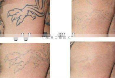 nd yag laser tattoo remover