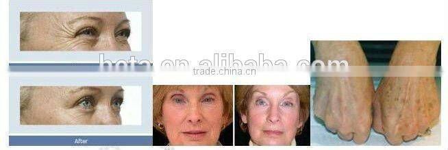 Guangzhou HETA Anti aging wrinkle machines fractional lift RF collagen whitening product