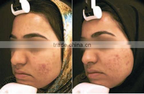 Hot New Products For 2015!ipl laser machine hair removal ipl,laser ipl hair removal machine,e-light ipl hair removal(HOTTEST!!!)