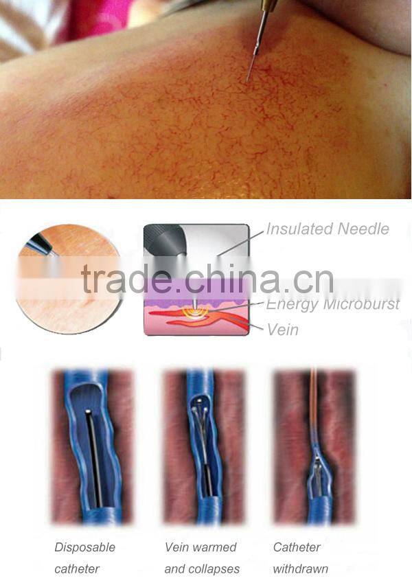 Removal facial thread veins with RBS machine