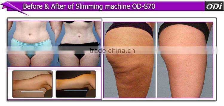 2015 Best valeshapeer infrared rf roller vacuum forming OD-S70