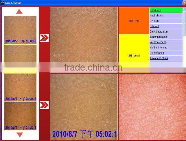 2015 Latest 3D Skin Analyzer/ Skin Analyser(English version software)