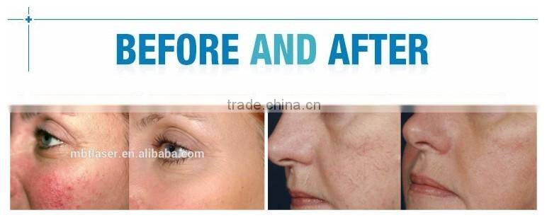 RBS 980nm laser vascular removal machine / vascular removal machine for home use
