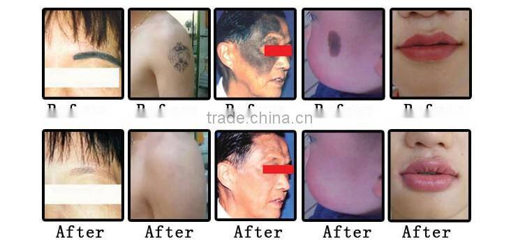 2000W big power q-switched nd:yag laser tattoo removal