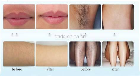 Higher energy e-light ipl shr hair removal laser machine for Spa and clinic