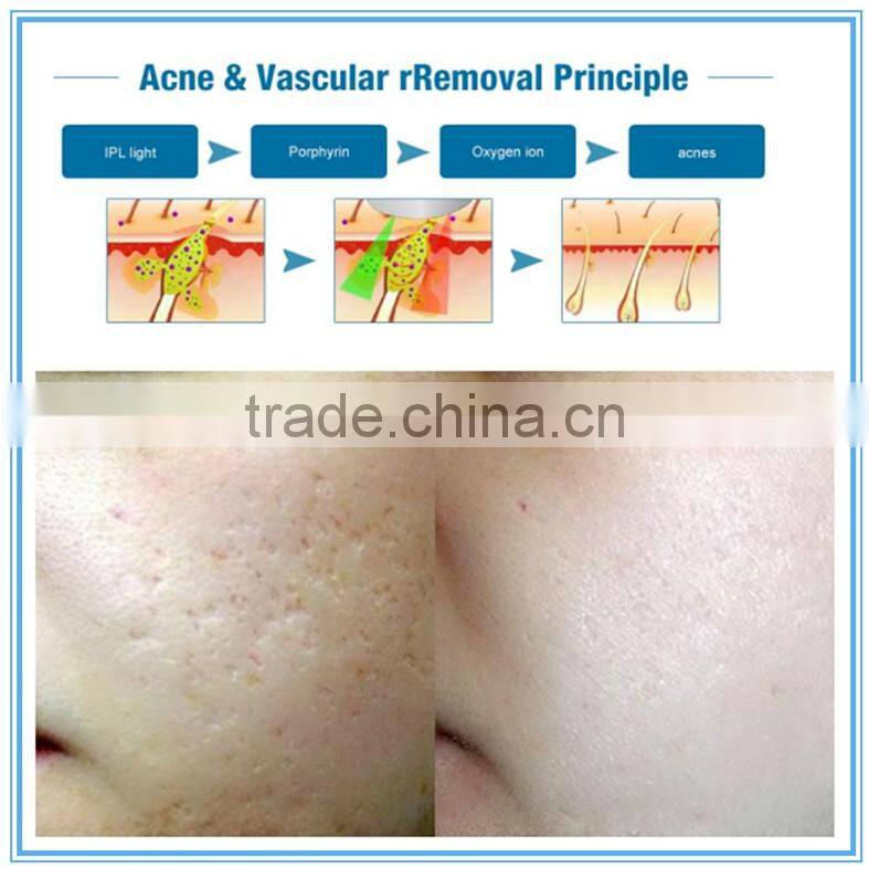 ipl laser hair removel epilation machine lumenis price for sale with ce