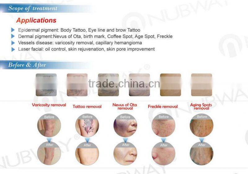 New design !! 1064 nm 532nm nd yag laser/long pulse nd yag laser