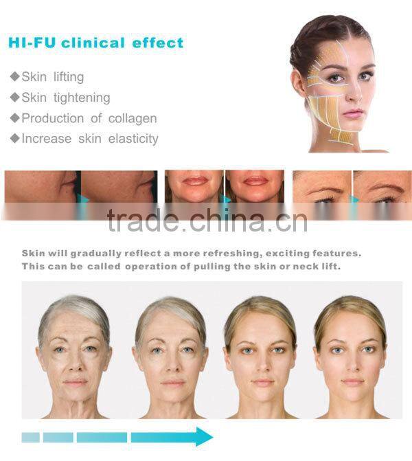 gezatone hifu home use cellulite machine