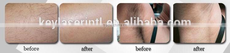 Best price 1 year warranty 50,0000 shot times ipl+rf+e light+anti age equipment