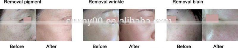 30w Fractional Co2 Laser Surgical Products