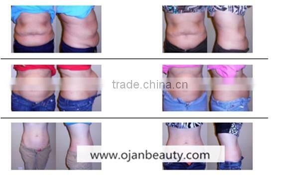 diode lipo light laser 635nm hair removal machine price