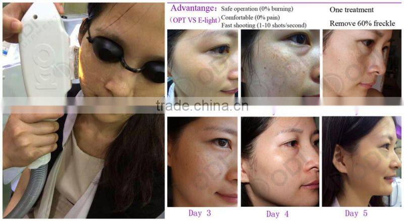 OPT ipl hair removal equipment with 80.000 shots ipl flash lamp