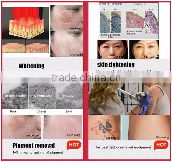 1064 nm / 532nm pigments tattoo removal varicose veins laser treatment q-switch nd yag laser
