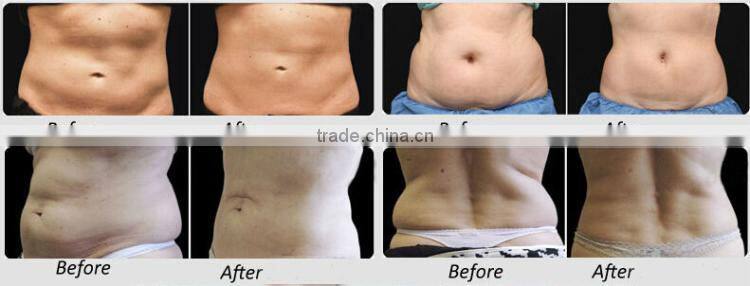 one treatment one size smaller 13mm hifu treatment hi fu lose weight fast machine