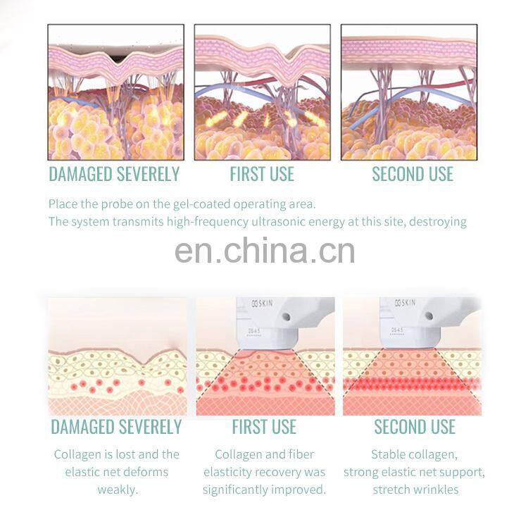 2 in 1 Anti-wrinkle portable Hifu Machine Wrinkle Removal / ultrasonic beauty machine for body