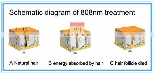 advanced 810nm diode laser hair removal dubai price