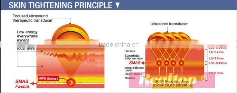 Distributor opportunities non invasive and painless smas tightening technology anti-aging wrinkle removal ultra lift hifu facial