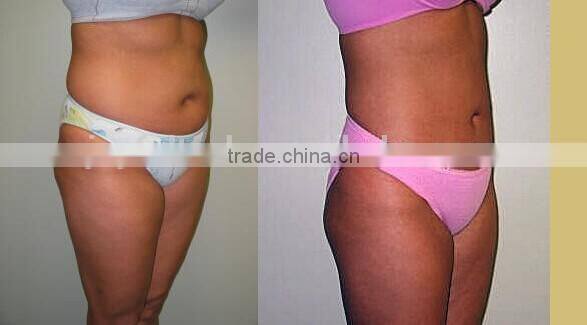 vaser liposuction machine