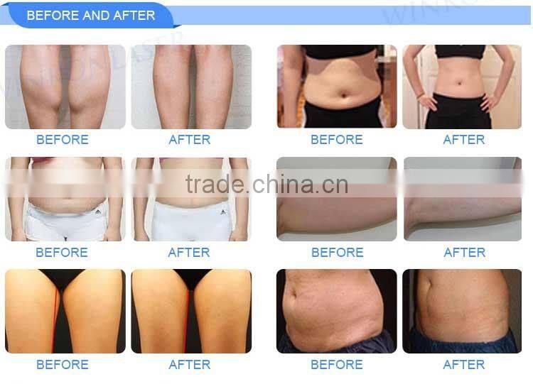 cryolipolysie / price cryolipolysis / cryolipolysis machine 2016