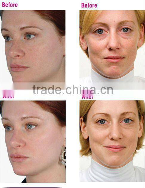 best pride for 200 needles derma roller with replacable head for skin cure