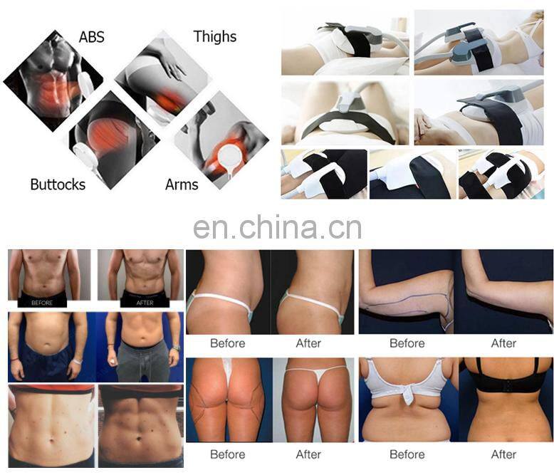 Non-Invasive ems neo RF fat burning body slimming muscle stimulator machine with 4 handles