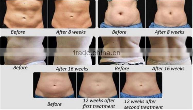 2015 hot sale portable Ultrasonic vacuum cavitation RF slimming beauty machine