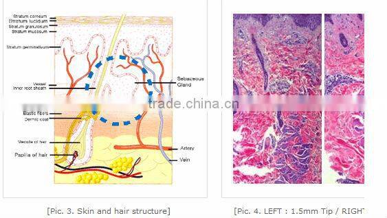 Personal care and beauty series product fractional rf skin lifting machine
