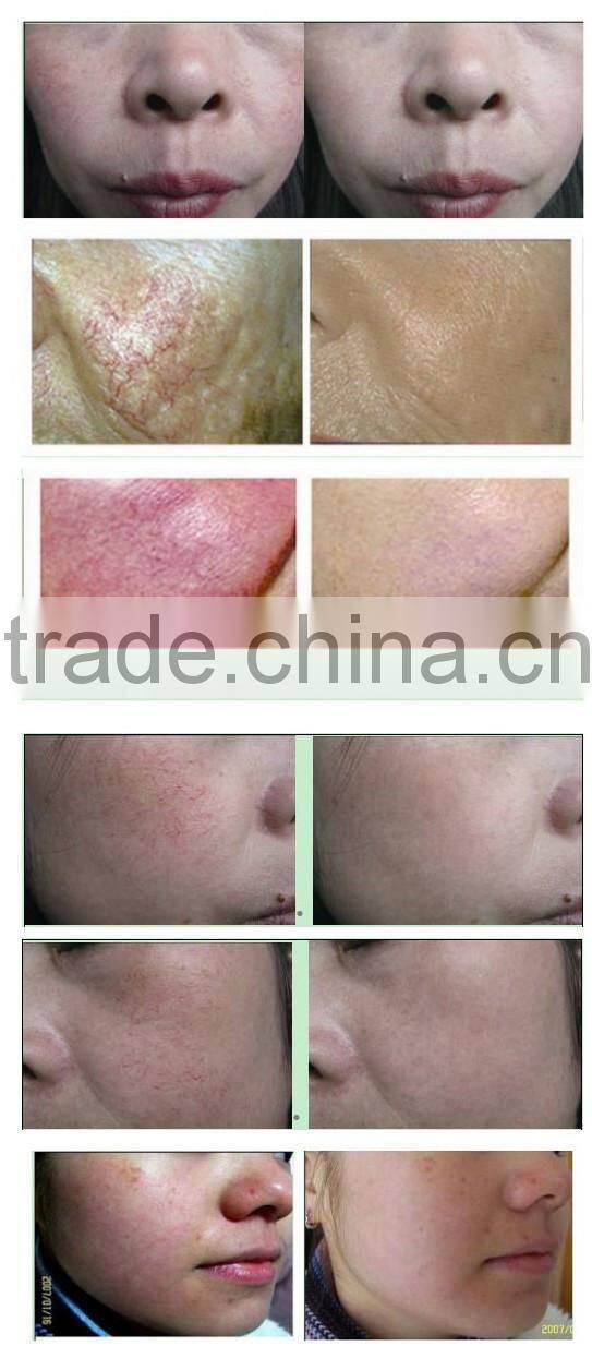 Best Effective RBS Vascular Therapy FDA Approval Spider Veins Laser Removal Machine