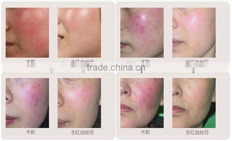 8.4 Inch Touch Screen Diode 980 laser Vascular care spider vein removal and varicose removal BD-980