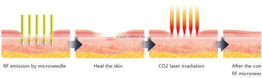 Unparalleled High Performance Skin Treatment 2MHz Radio Frequency fractional rf beauty device