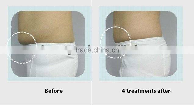 2015 portable&home use cavitation slimming system