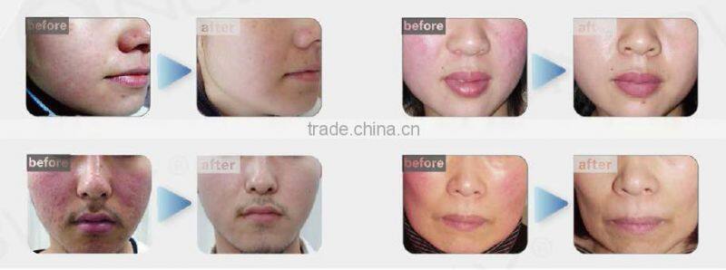 Best RBS Laser Spider Vein Removal Varicose Veins Laser Treatment Machine NBW-V600