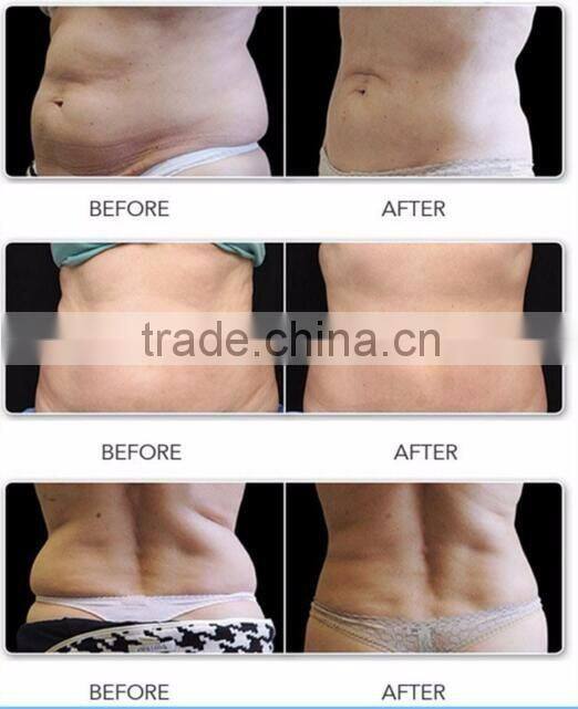 portable vevazz lipo laser reviews