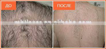 MBT LASER shr ipl Professional Multifunction digital permanent hair removal skin rejuvenation opt machine