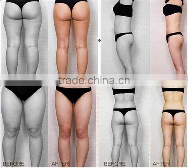 2016 Lipohifu ultrasonic liposuction body slimming machine - JT-Slim1