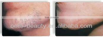 Portable depilation laser spider vein removal machine