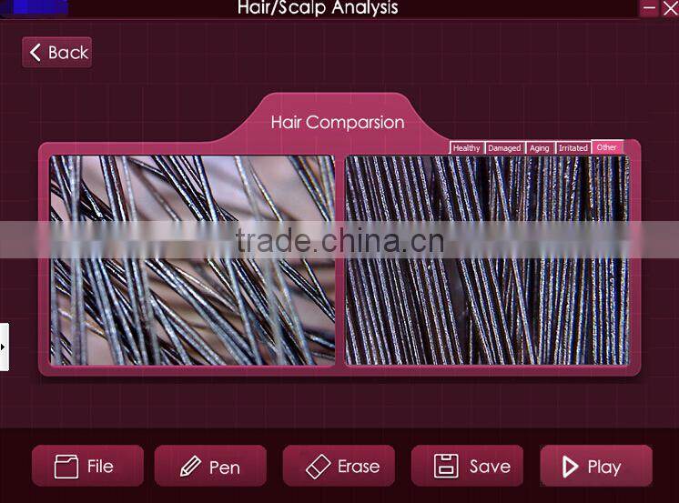 200X digital microscope scalp detector