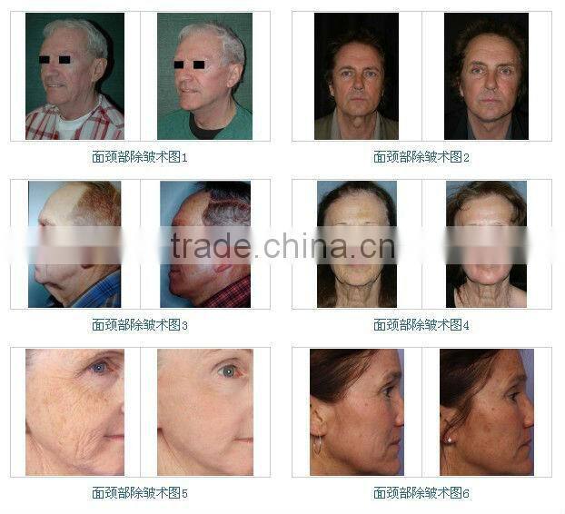 Skin Care Machine for Anti-aging Skin Rejuvenation BD-SP002