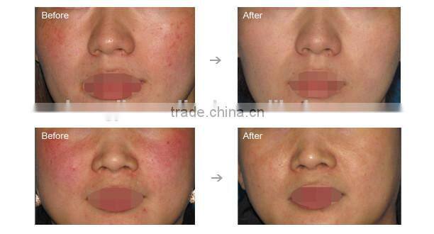 HOT!!!2014 best selling spider vein removal machine,laser vein removal machine for sale