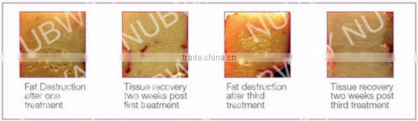 Non-invasive Fat Cell Destruction Fast Weight Loss HIFU Body Slimming Machine