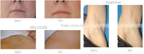 HOT-selling !!! professional portable 808nm diode laser hair removal machine for beauty salon