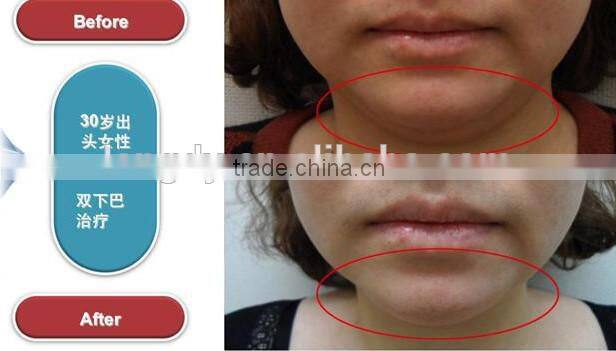 2015 newest high intensity focused ultrasound hifu/ face lifting/anti-aging/ wrinkle removal