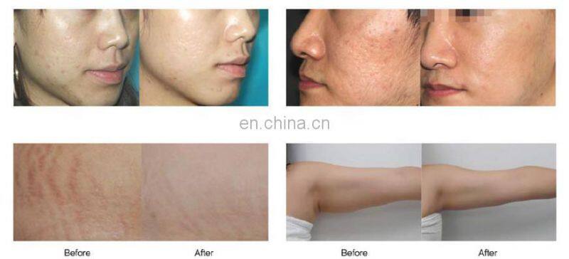 2015 Matrix Fractional Microneedle RF& microneedle Fractional RF for face lifting with CE, ISO