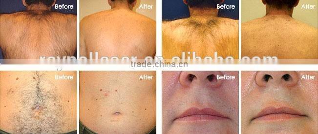 Microcomputer 600w 808nm Portable Salon Use Best Laser Hair Removal System with German Laser