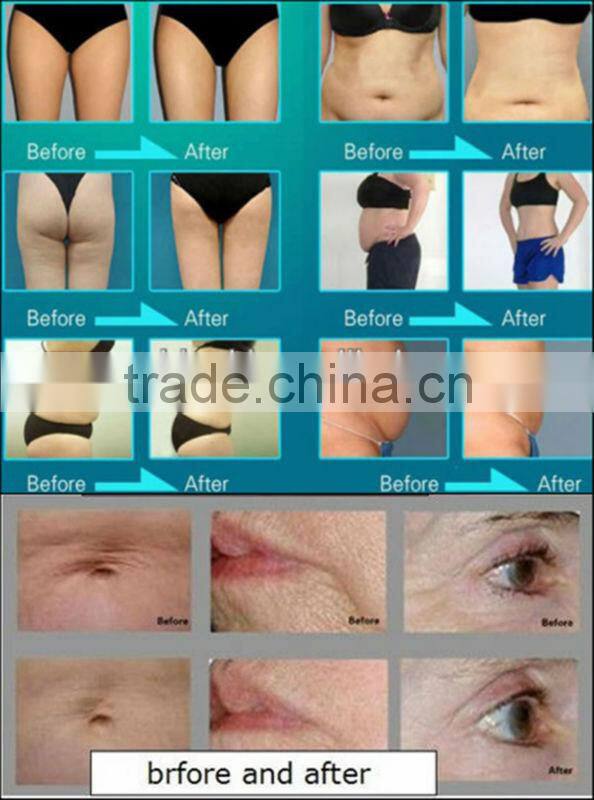 CE approved 5 IN 1 cavitation cellulit reduction with VACUUM RF