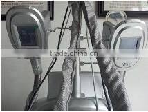 cold fat liposuction criolipolysis fat freezing