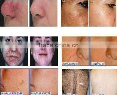 Hot sale!!! China Top Selling Portable Small Hair Removal IPL Device aesthetics equipment