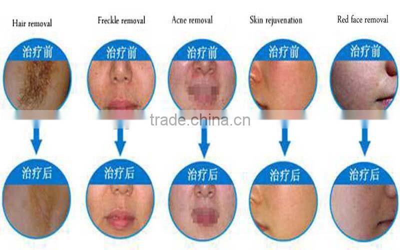 2015 portable small mini opt ipl rf esthetician big spot size beauty equipment for sale