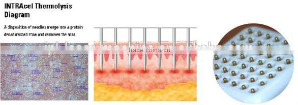 Best Selling rf fractional micro needle portable